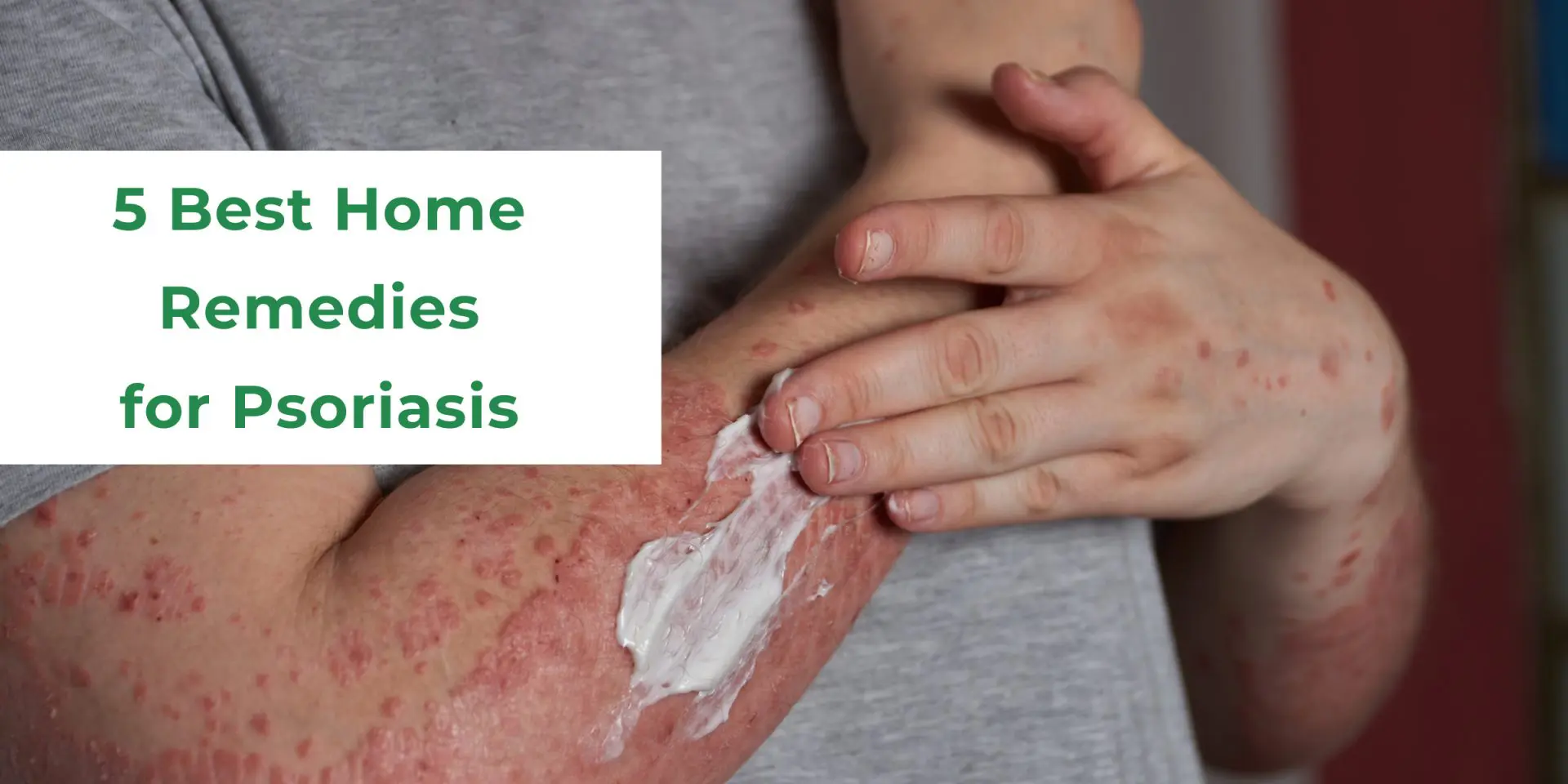 Psoriasis A Skin Condition That Needs Attention