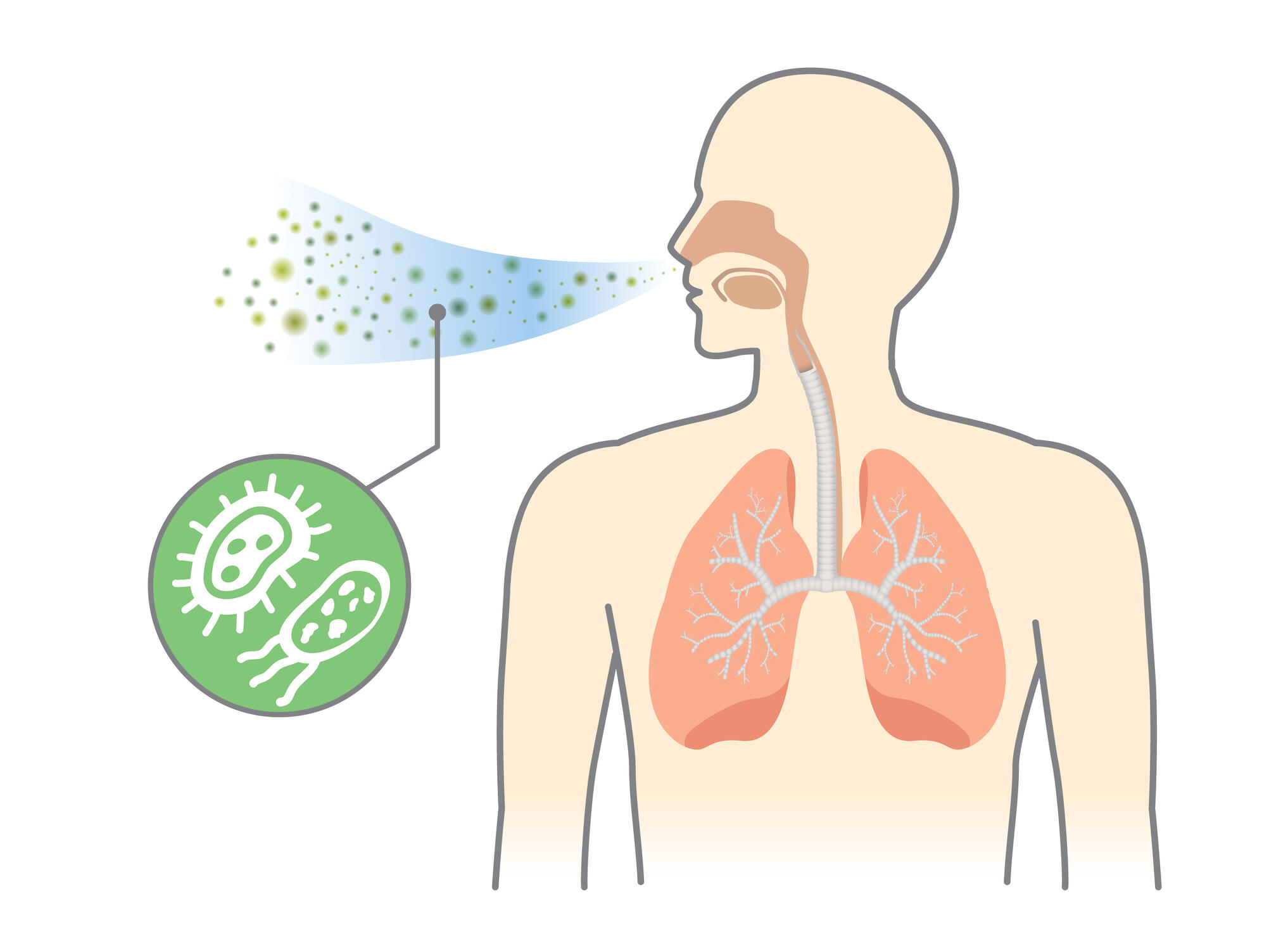 Pneumonia A Serious Lung Infection